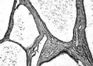 Nefropatia Familiar - FN